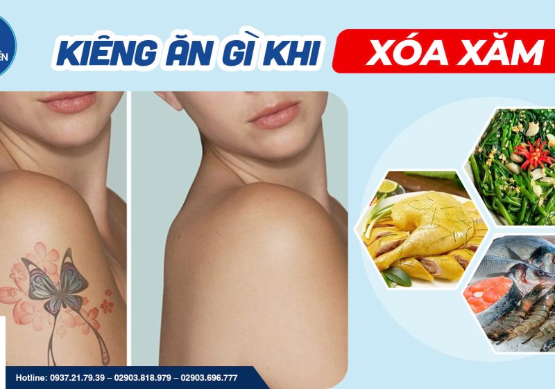 Kiêng ăn gì khi xóa xăm